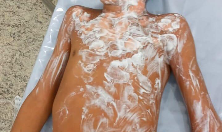 Menino de 8 anos socorrido em chamas após ser abandonado pela avó teve queimaduras no rosto e tórax