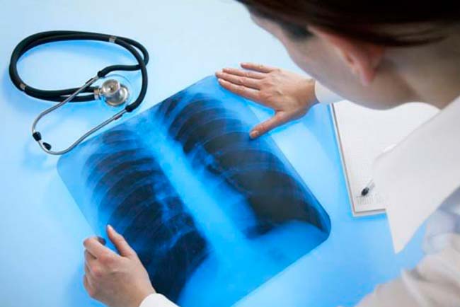 SUS discute distribuição gratuita de remédio para hipertensão pulmonar