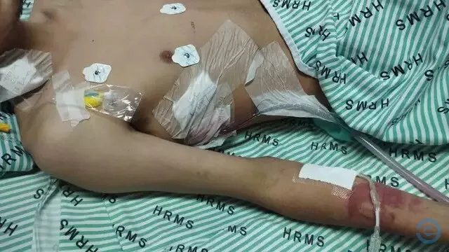 Paulo, jovem de 22 anos perde parte do pulmão por usar vape e narguile