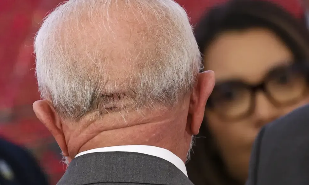 Novo procedimento em Lula já estava previsto após cirurgia, diz equipe