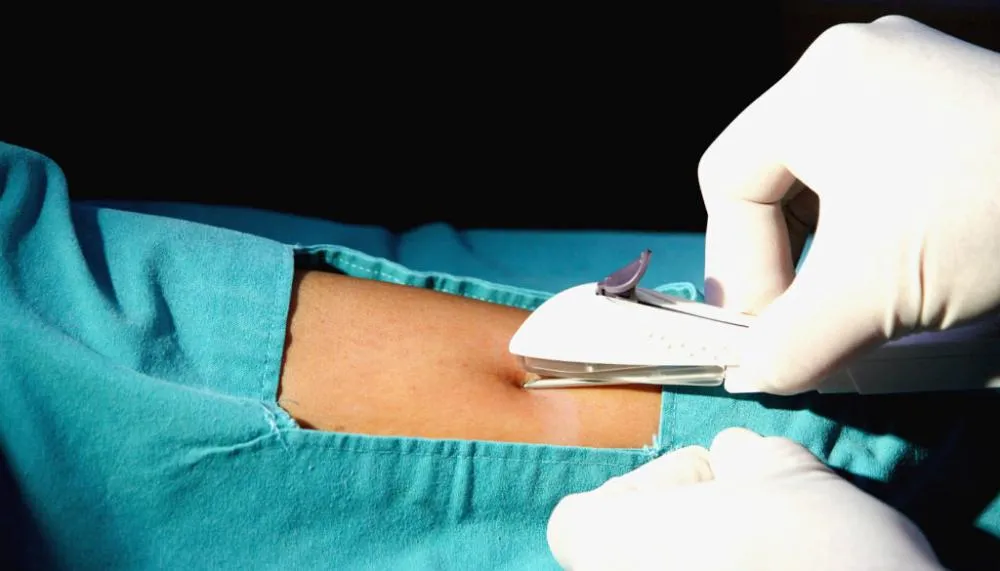 Implante contraceptivo entra na cobertura obrigatória dos planos de saúde