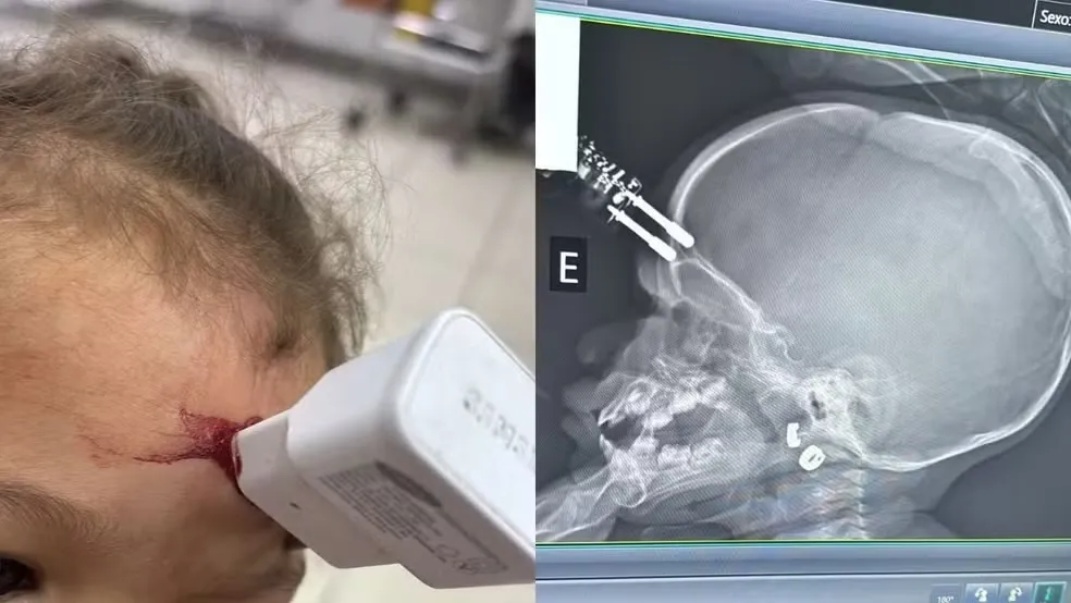 Bebê de 1 ano cai da cama e tem carregador de celular cravado na cabeça